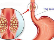 Sức khỏe đời sống - Hãy ngừng ngay thói quen này nếu không muốn rước ung thư thực quản