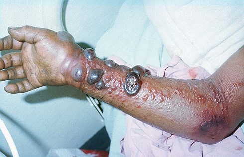 Ảnh cánh tay của một bệnh nhân Ebola.