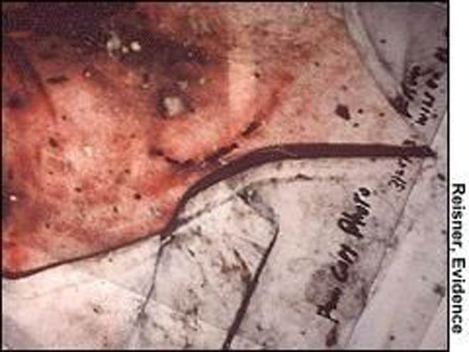 Những vết cắn trên thi thể Donna Paynant.