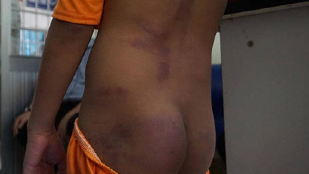 Hình ảnh một học sinh bị đánh với chi chít vết bầm tím trên người. Ảnh: B.G