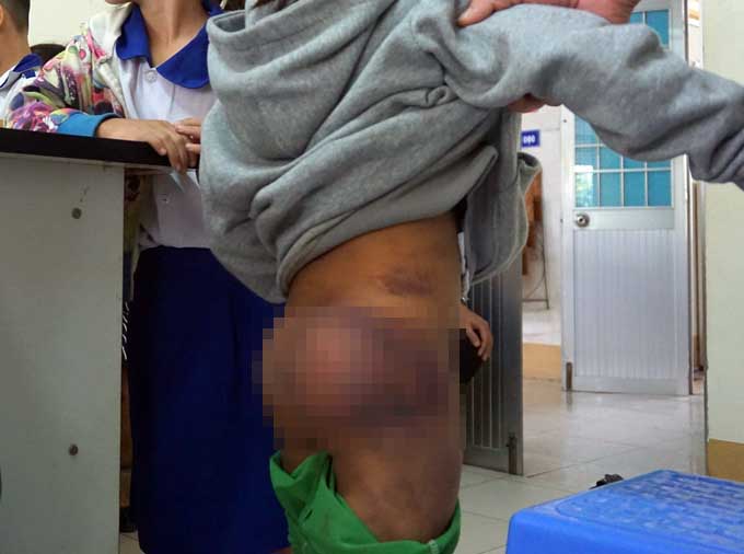 Thầy cô trường Tiểu học Trần Quốc Toản&nbsp;(xã An Xuyên, TP.Cà Mau) phát hiện 4 học sinh của trường đến lớp với nhiều vết bầm trên người.