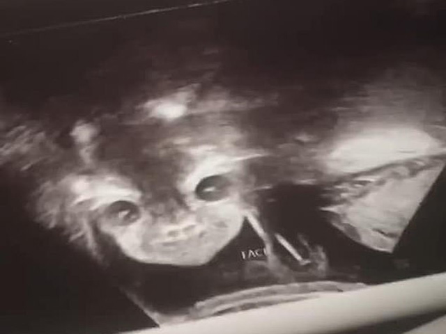Thú vị hình ảnh siêu âm thai nhi 24 tuần tuổi mở mắt, cười bí hiểm