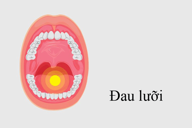 5. Đau lưỡi: Lưỡi là bộ phận rất nhạy cảm. Vì vậy, nếu nhận thấy bất cứ tổn thương nào gây đau ở lưỡi cần cẩn thận và sớm tìm ra nguyên nhân chính xác.
