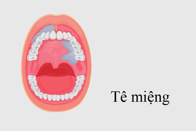 7. Tê miệng: Nếu một khối u ung thư miệng đủ lớn để làm tổn thương dây thần kinh trong miệng, bạn có thể nhận thấy tê ở một khu vực cố định trong miệng.
