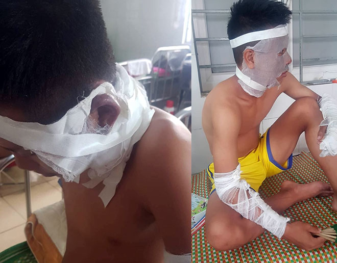 Hai trong ba cầu thủ U14 - Câu lạc bộ Sông Lam Nghệ An bị bỏng nặng