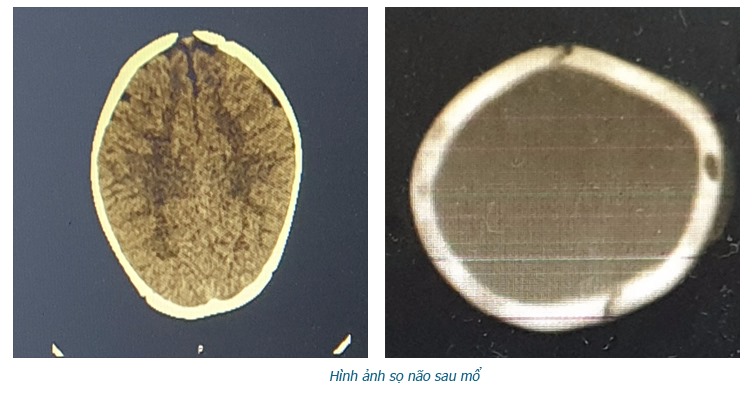 Ngã xe tập đi, bé 8 tháng tuổi bị lún sọ não - 1