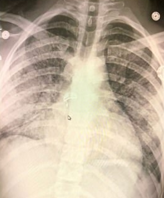 Chàng trai 18 tuổi bị tổn thương phổi vĩnh viễn vì thuốc lá điện tử - 1
