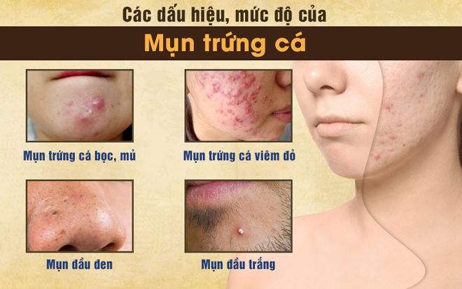 Mụn trứng cá là gì? Nguyên nhân và cách điều trị đạt hiệu quả cao - 2