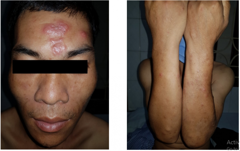 Bệnh phong: Căn bệnh tưởng chừng bị lãng quên lại &#34;tái xuất&#34; - 1