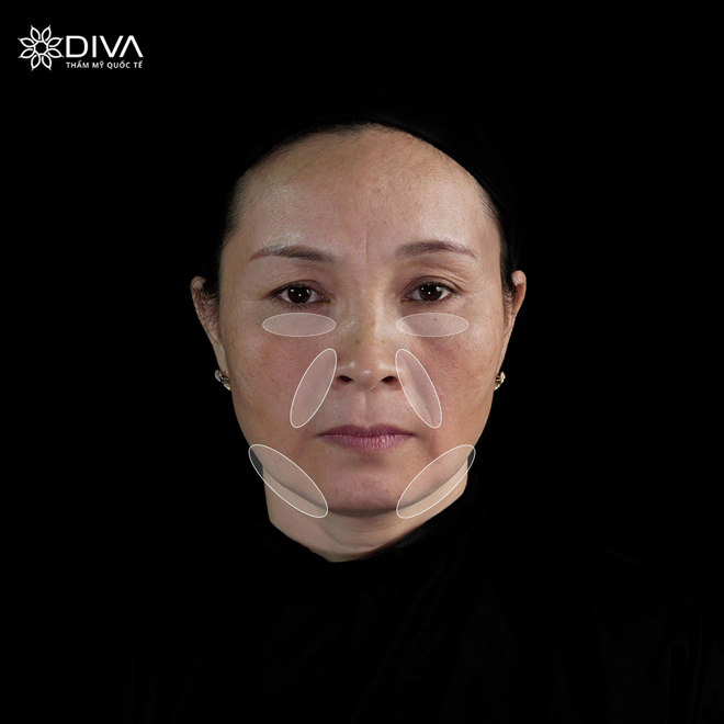 Hậu quả của vấn đề lão hóa thường biểu hiện cùng lúc như: da lỏng lẻo chảy xệ, rãnh má mũi sâu và những khuyết hõm trên khuôn mặt