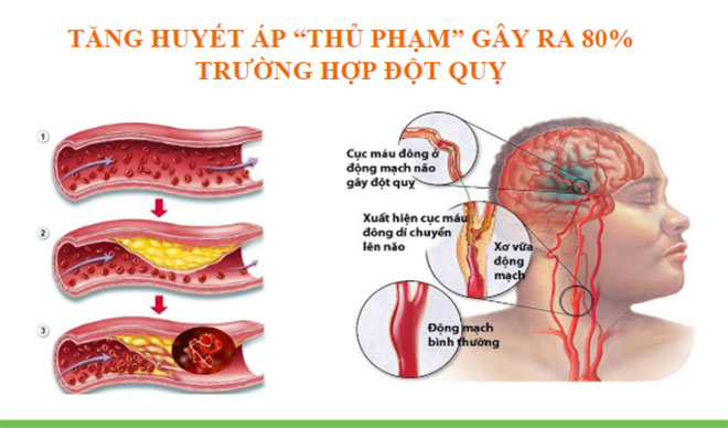 Xu hướng mới trong hỗ trợ điều trị tăng huyết áp và phòng ngừa đột quỵ - 1