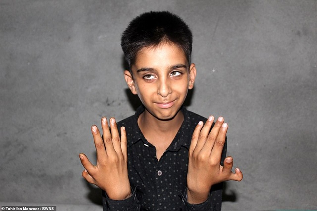 Cậu bé có 12 ngón tay: Không xấu hổ, tự hào vì nhiều ngón tay mà chơi game giỏi - 1