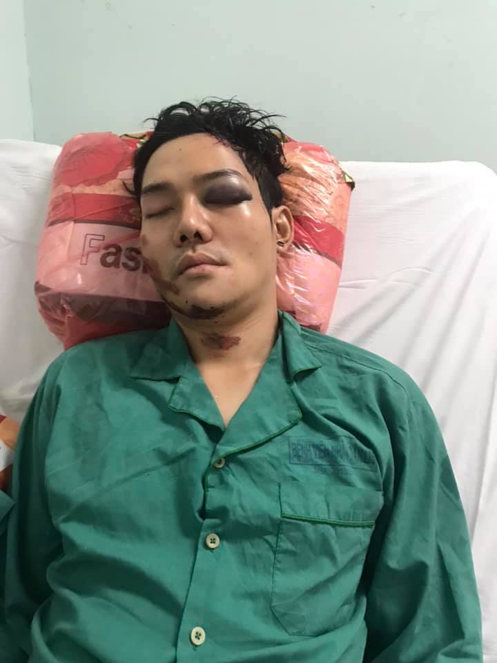 Cao Hữu Thiên gặp tai nạn giao thông nghiêm trọng vào hồi tháng 4
