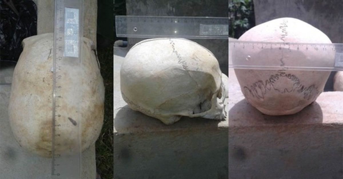 Cận cảnh những hộp sọ bị kéo dài bất thường về phía sau và hơi chếch lên, gần giống sọ hình quả trứng của người Neanderthals - ảnh do nhóm nghiên cứu cung cấp