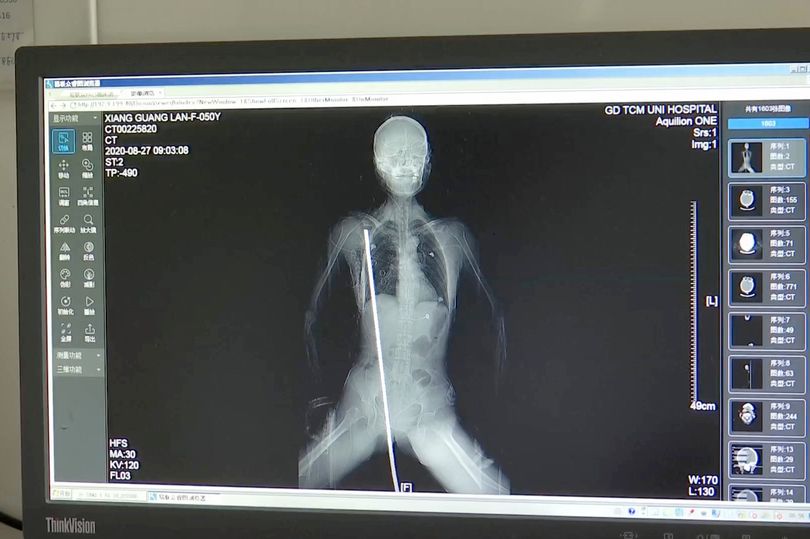 Ảnh chụp X quang thanh thép đâm xuyên suốt cơ thể cô Xiang Guanglan (ảnh: Daily Star)