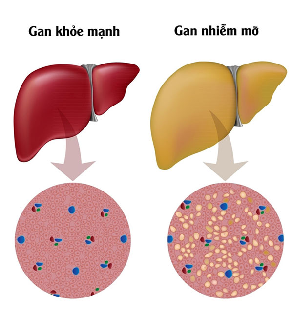 Mỡ thừa xuất hiện tại mô gan gây chèn ép lên các tế bào gan, làm ảnh hưởng trực tiếp đến chức năng gan.