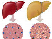 Tin tức sức khỏe - Gan nhiễm mỡ: Bệnh không đơn giản và những hiểu nhầm chết người