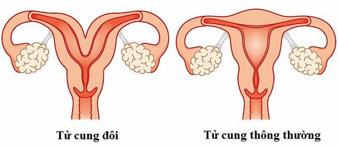 Hiếm gặp: Người phụ nữ 20 tuổi có 2 tử cung - 1