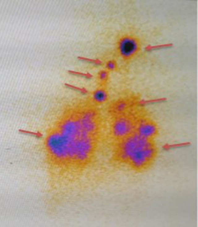Hình ảnh xạ hình toàn thân với I-131 sau điều trị vào tháng 6: di căn hạch cổ, hạch trung thất, di căn 2 phổi (mũi tên đỏ).