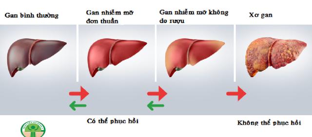 Diễn tiến bệnh gan nhiễm mỡ không do rượu