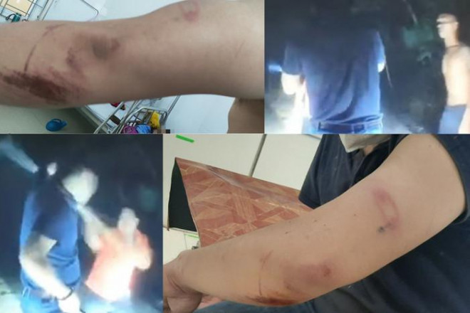 Hai đối tượng tấn công anh Hào gây nên tình trạng đa chấn thương cho nạn nhân