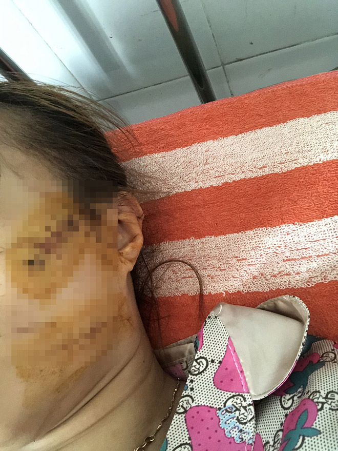 Vết thương tại mặt, tai của chị L. do chồng gây ra.