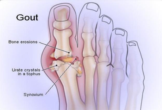 Bệnh gút là một loại viêm khớp do sự hình thành các tinh thể axit uric trong khớp và gây đau đớn.