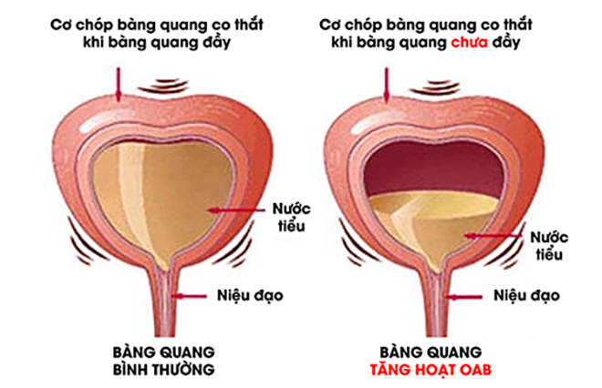 Dấu hiệu tiểu nhiều lần cả ngày lẫn đêm cảnh báo bàng quang bị bệnh này, phòng tránh sớm kẻo ân hận - 3