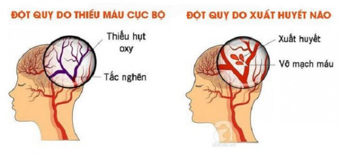 Hình ảnh đột quỵ do xuất huyết não và đột quỵ do thiếu máu cục bộ