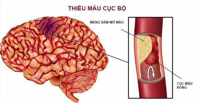 Thiếu máu cục bộ do huyết khối gây đột quỵ cần được xử lý cấp cứuXử trí bệnh nhân dương tính với COVID-19