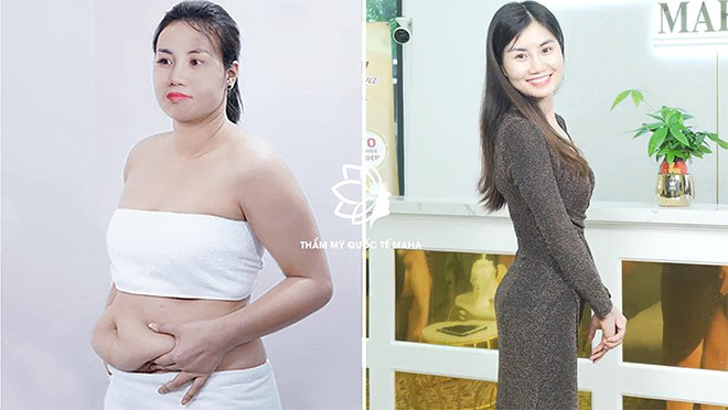 Hình ảnh chị Nguyệt trước và sau khi giảm béo toàn thân