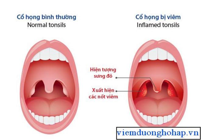 Minh họa cổ họng bị viêm, tổn thương dẫn đến đau rát, tiết đờm và ho