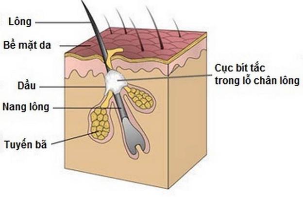 Hình ảnh tắc lỗ chân lông.