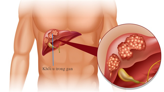 Đằng sau mỗi căn bệnh là một thói quen xấu, thay đổi ngay kẻo “rước họa vào thân” - 6