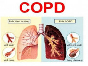 Sức khỏe đời sống - Lactoferrin dưỡng chất vàng cho bệnh nhân COPD, hen suyễn không thể bỏ qua!