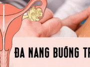 Sức khỏe đời sống - Đa nang buồng trứng và nguy biến khó lường