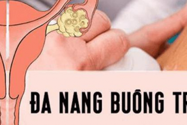 Đa nang buồng trứng và nguy biến khó lường