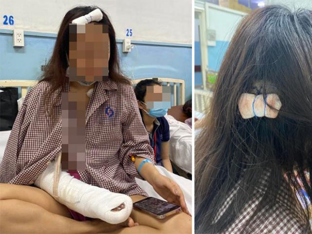 4 cô gái bị đánh đập vì mời bia không uống: Nạn nhân đứt gân tay, chi chít vết thương