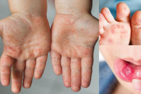 Bệnh tay chân miệng ở Hà Nội tăng hơn 5 lần, những sai lầm cha mẹ cần tránh