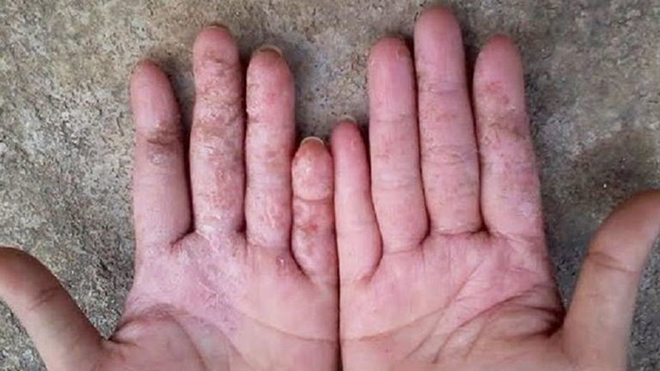 Viêm da chữa mãi không khỏi, Phó Giáo Sư mách mẹo này “mừng như bắt được vàng” - 3