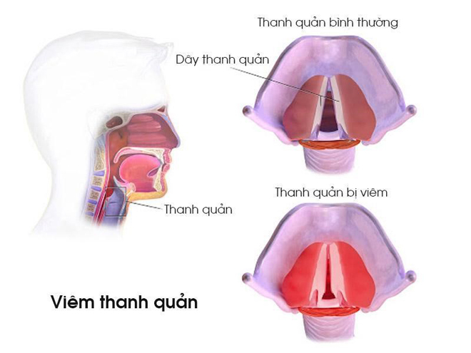 Viêm thanh quản mạn tính gây khàn tiếng, mất tiếng kéo dài