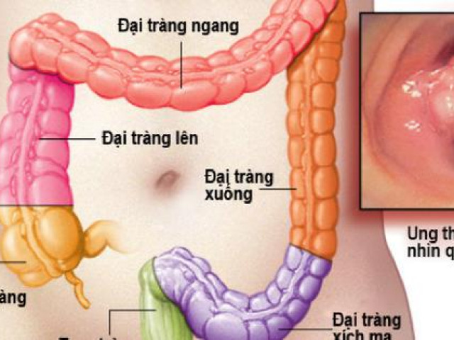 Cảnh báo 5 loại thực phẩm tăng nguy cơ ung thư trực tràng, người Việt hãy dừng ngay hôm nay!