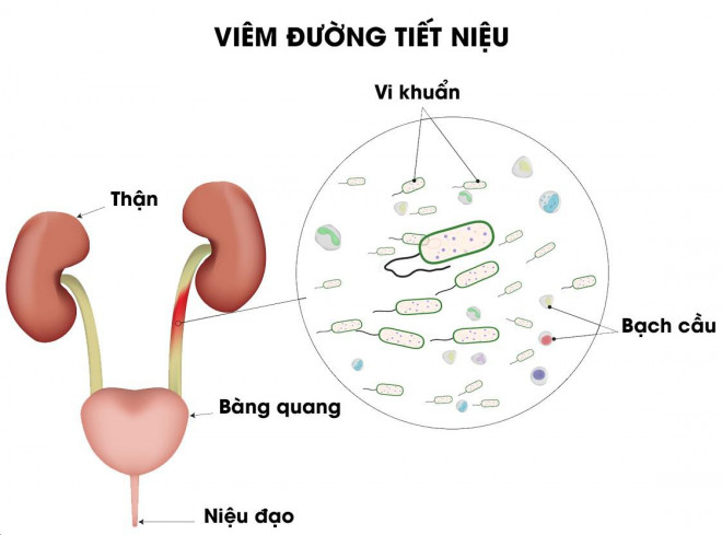 Cẩn thận với các biến chứng khi quý ông bị viêm đường tiết niệu - 2