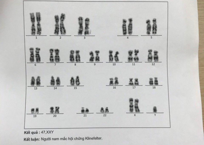 Ở hội chứng Klinefelter, nam giới sẽ mang nhiễm sắc thể là 47, XXY.