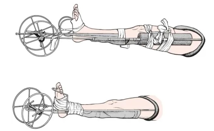 Lịch sử điều trị gãy xương, từ nẹp gỗ đến cố định bằng đinh vít - 3