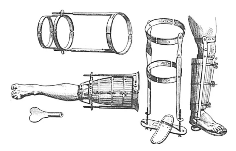 Lịch sử điều trị gãy xương, từ nẹp gỗ đến cố định bằng đinh vít - 1