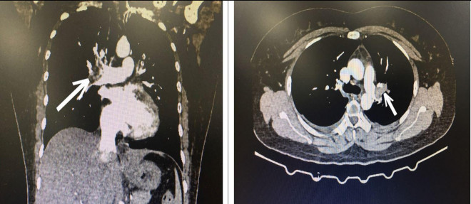 Hình ảnh CT lồng ngực bệnh nhân bị tắc động mạch phổi cấp tính. Ảnh BVCC