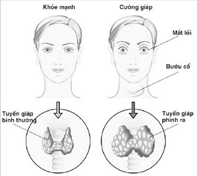 Bệnh tuyến giáp có nguy hiểm không & cách đối phó - 2