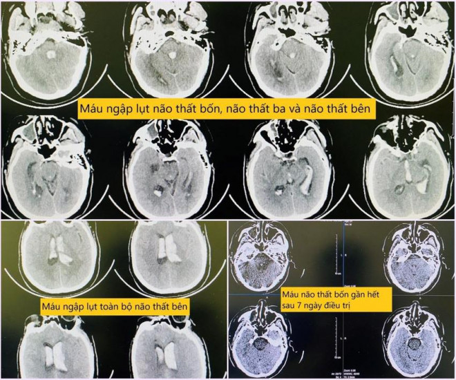 Hình ảnh chụp phim sọ não khi bệnh nhân nhập viện và sau quá trình điều trị.