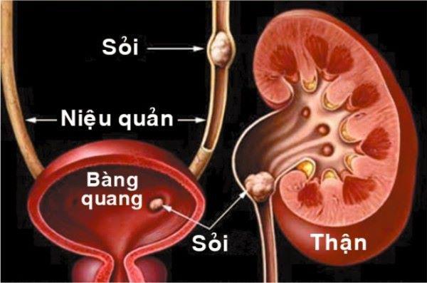 Các vị trí sỏi thường gặp trên đường tiết niệu.